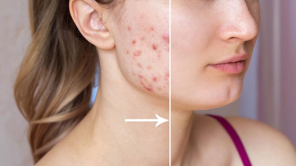 Facial Acne Control