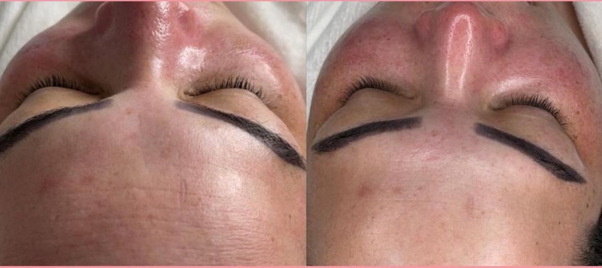 Hydrofacial