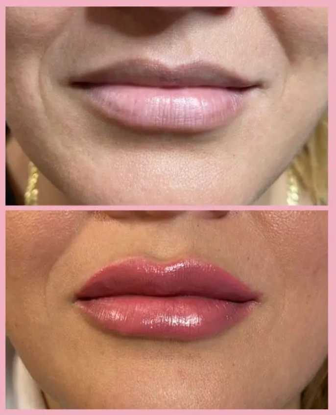 Lip Fillers