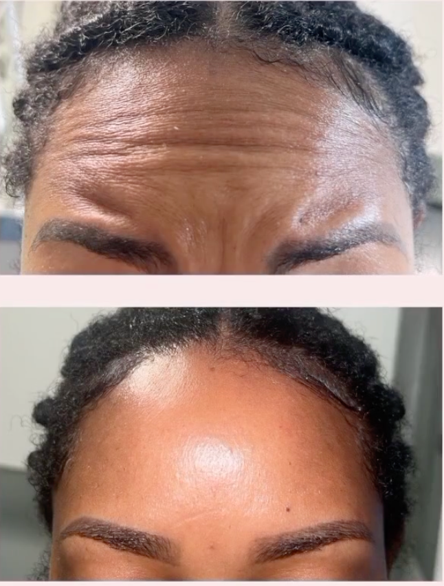 Botox