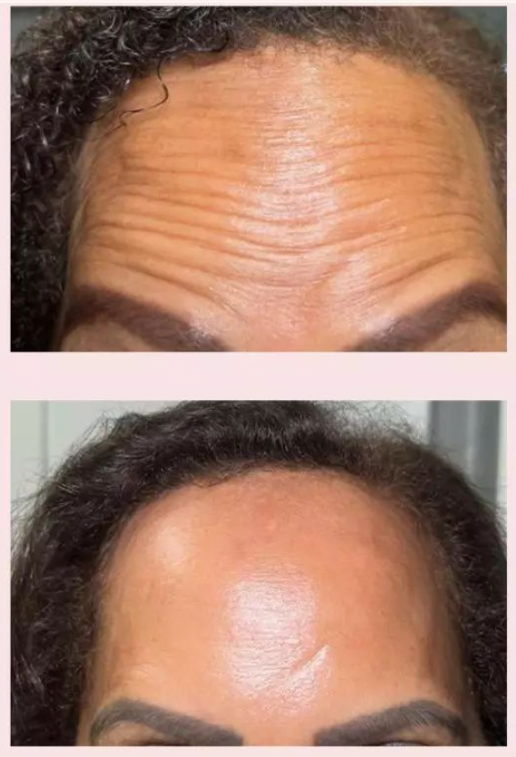 Botox