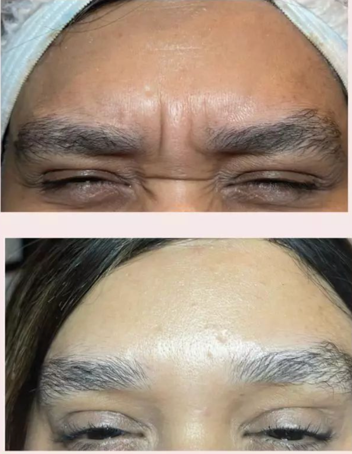 Rejuvenecimiento Facial