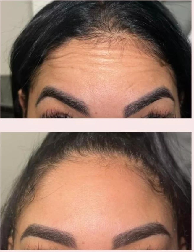 Botox
