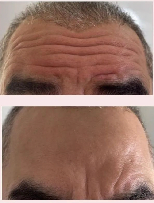 Botox