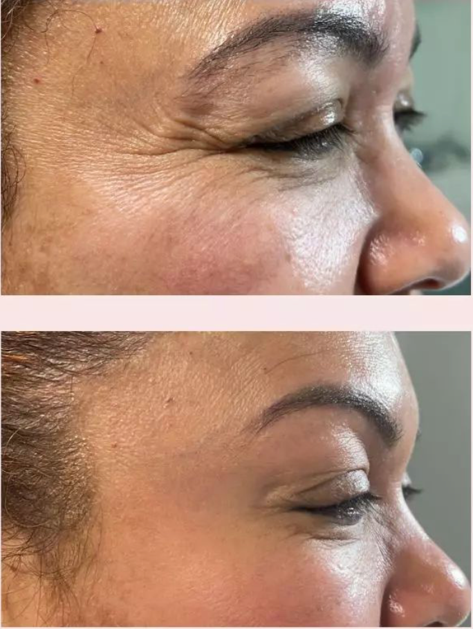Botox