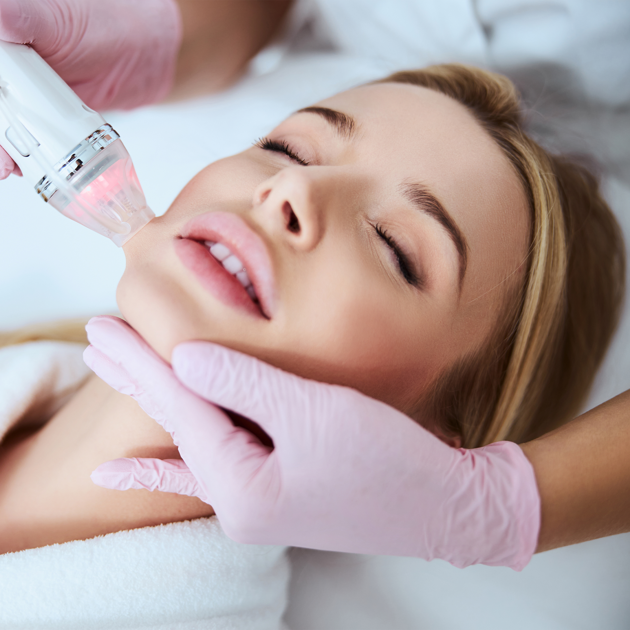 PLASMA FACIAL + FRACTIONATED RADIOFREQUENCY