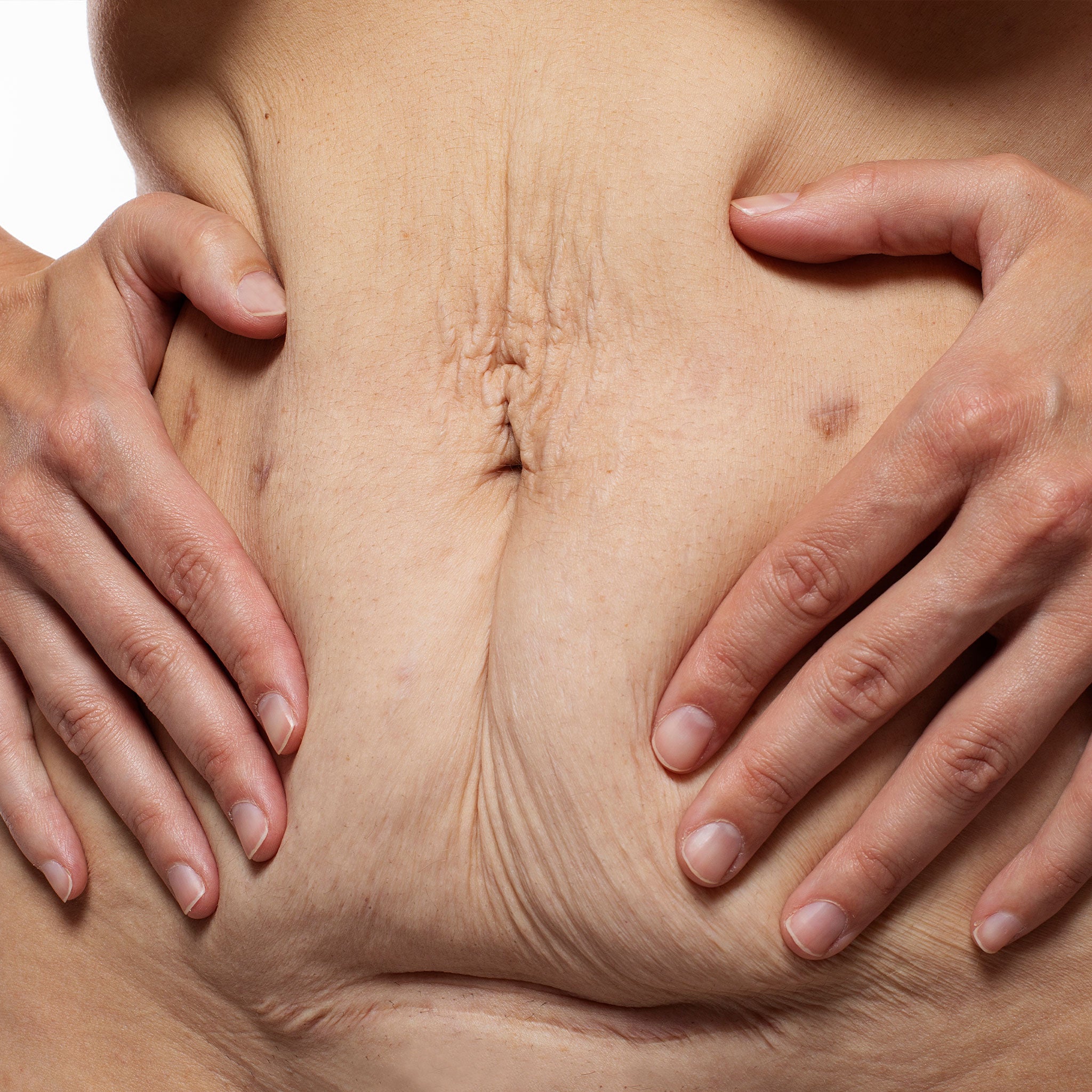 CO2 Cicatriz Tummy Tuck