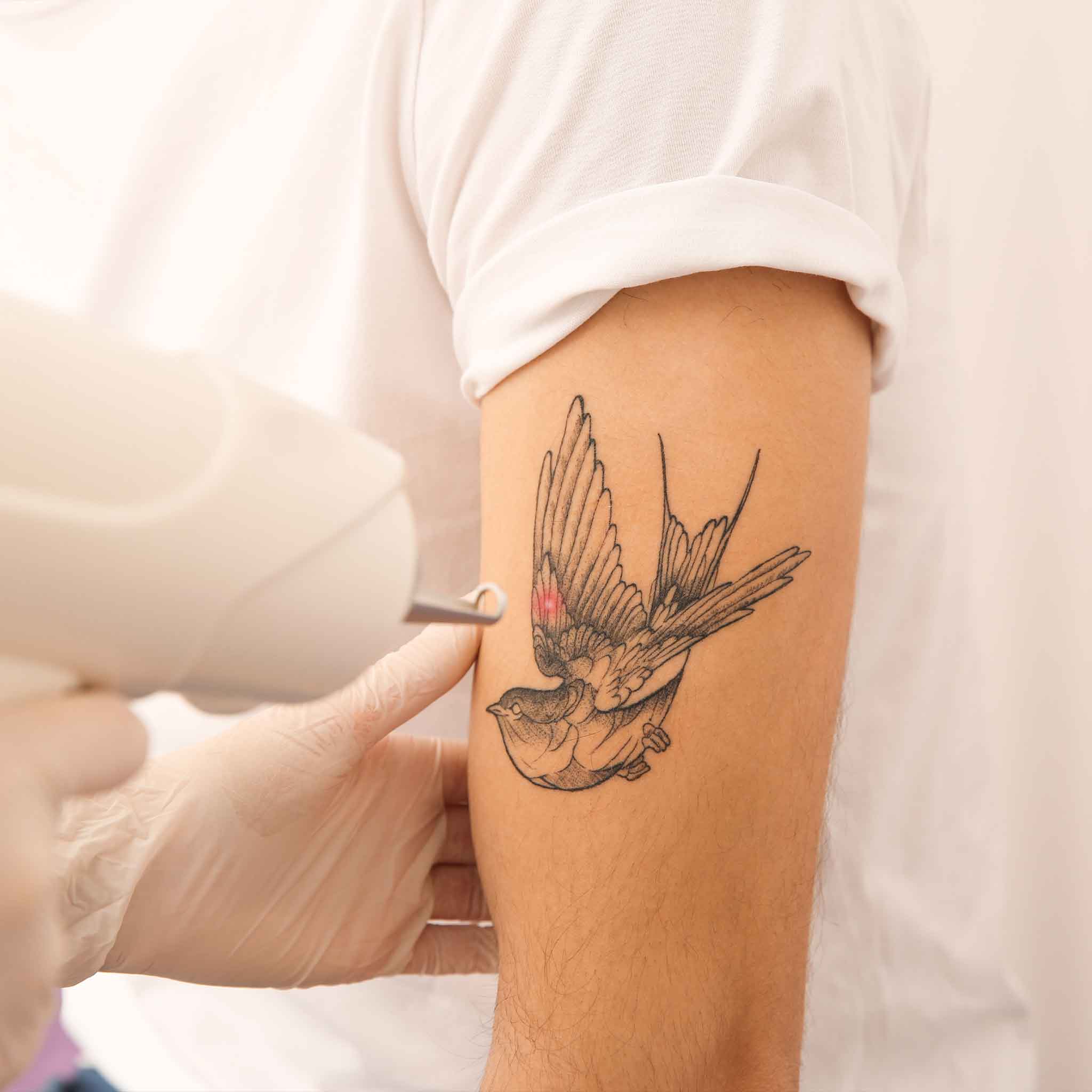 Tattoo Removal