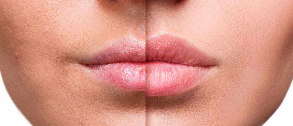 HYALURONIC ACID REMOVAL AND 1 CC JUICY LIPS