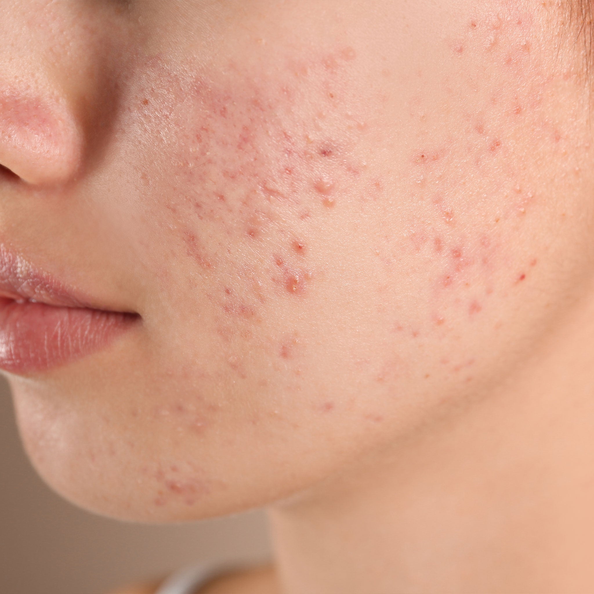 CO2 Acne (Acne Scars and Marks)
